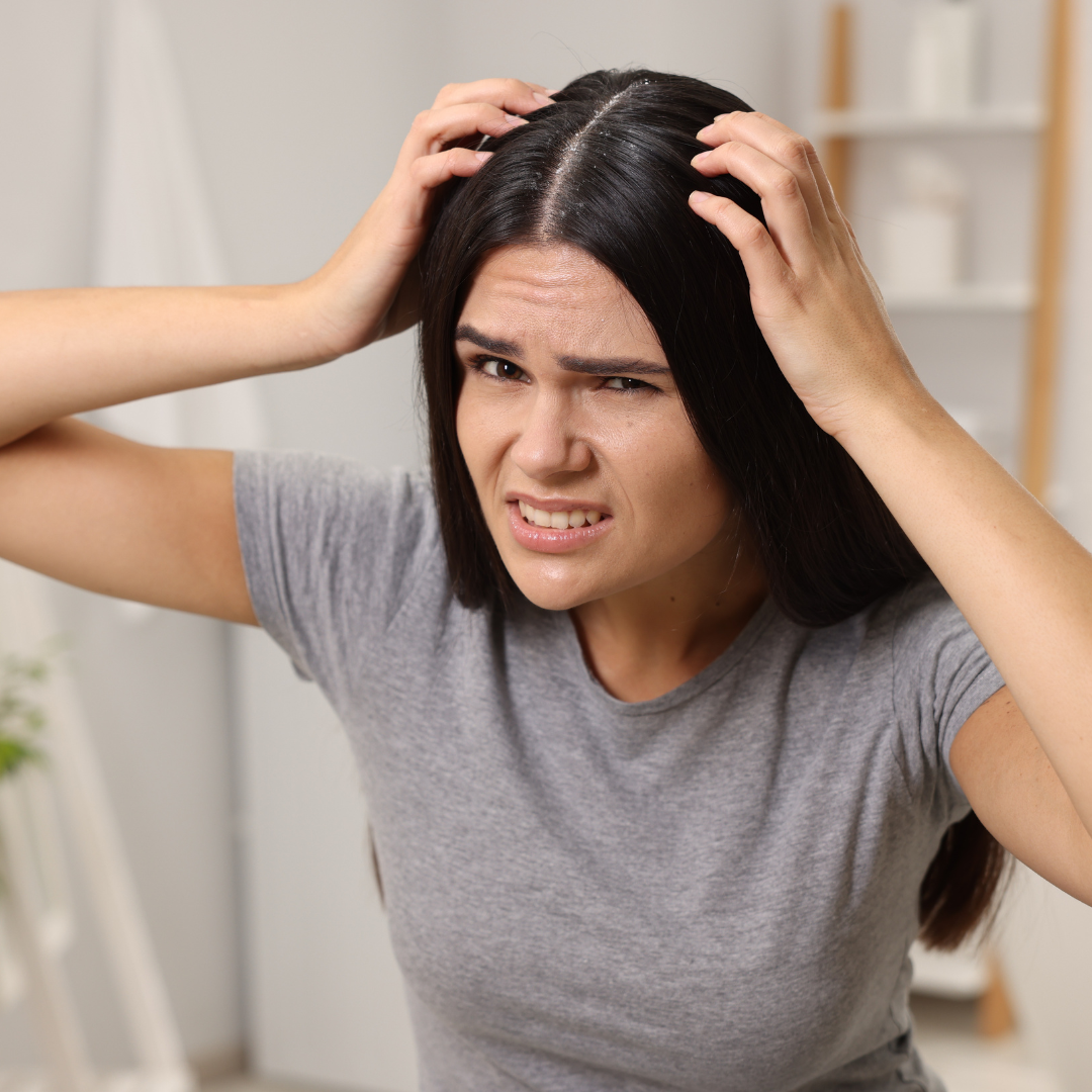 Itchy & Dandruff Scalp