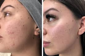 5% Lactic Acid + 3% Flower Acids Face Serum | Gently Exfoliates & Brightens Skin