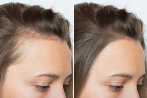 Intense Scalp Therapy Oil |Root-Nourishing | Hair Loss Control | 100% Natural Oil Therapy